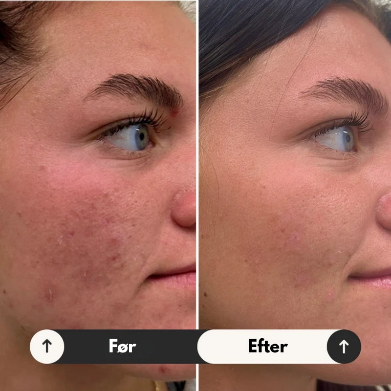 GlowRestore – Kojic og gurkemeje glødpads til lysnende og jævn hudtone (1+1 Gratis)